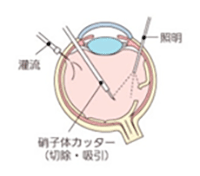 硝子体手術