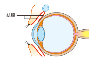 アレルギー性結膜炎とは