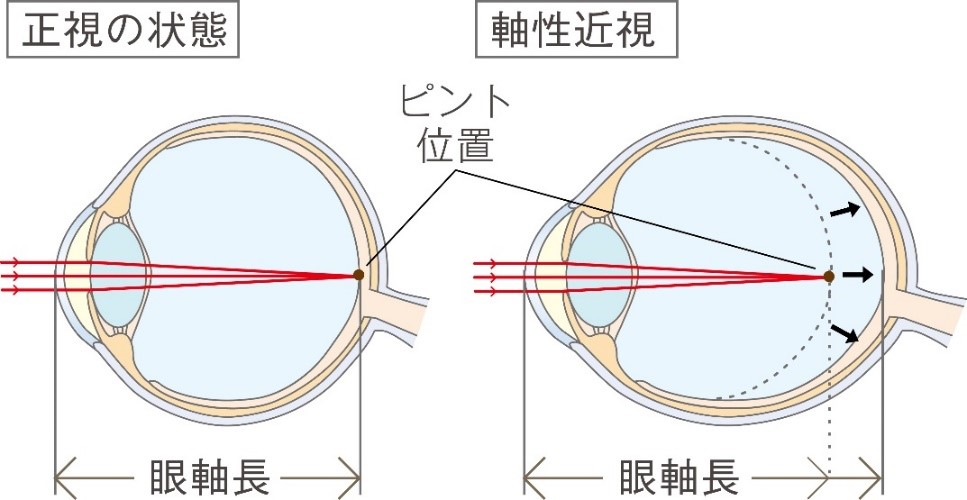 近視の進行を抑制することが大切な理由