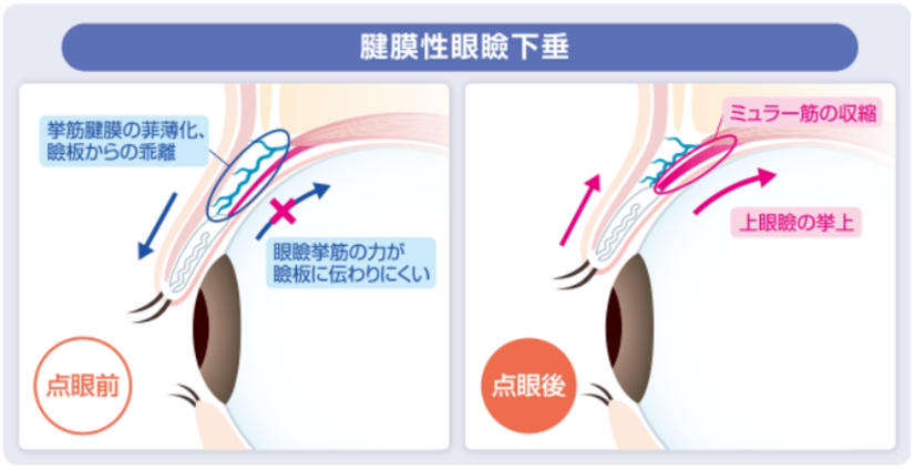 眼瞼下垂